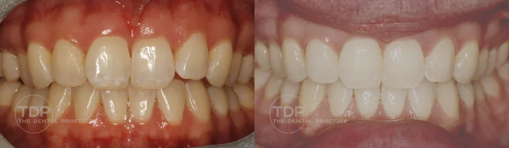A patient before and after cosmetic treatment