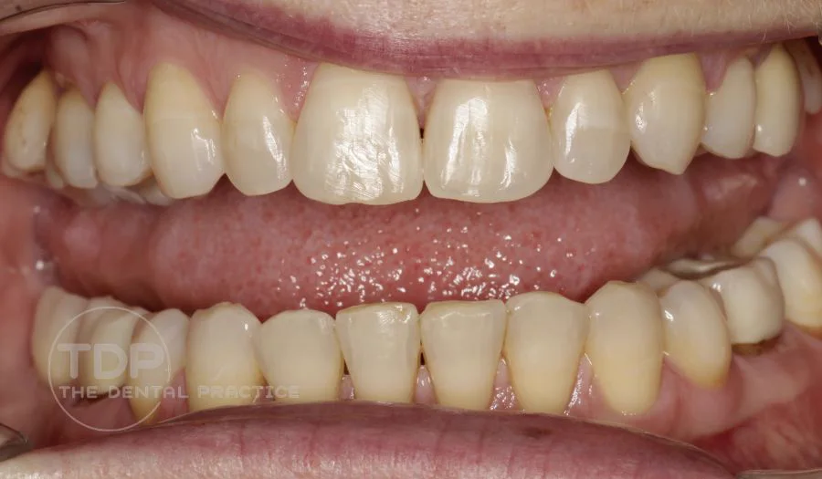 A teeth straightening result at The Dental Practice