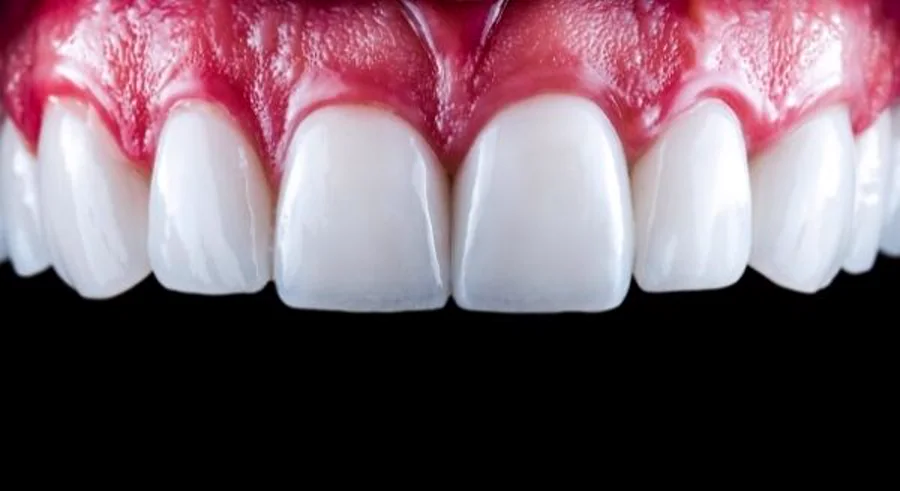 A porcelain veneer result at The Dental Practice